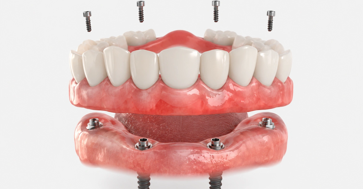 Turkey Tooth Implant1